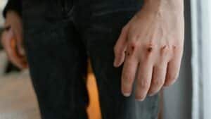 Detailed image of a hand with visible wounds and scratches, emphasizing injury.