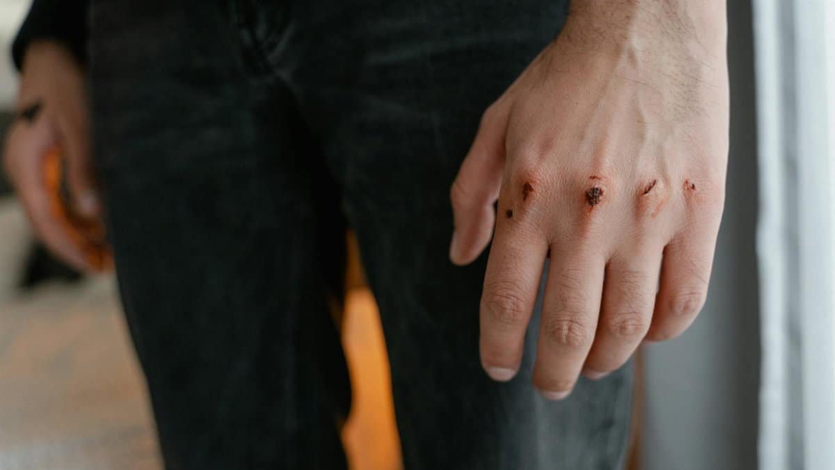 Detailed image of a hand with visible wounds and scratches, emphasizing injury.