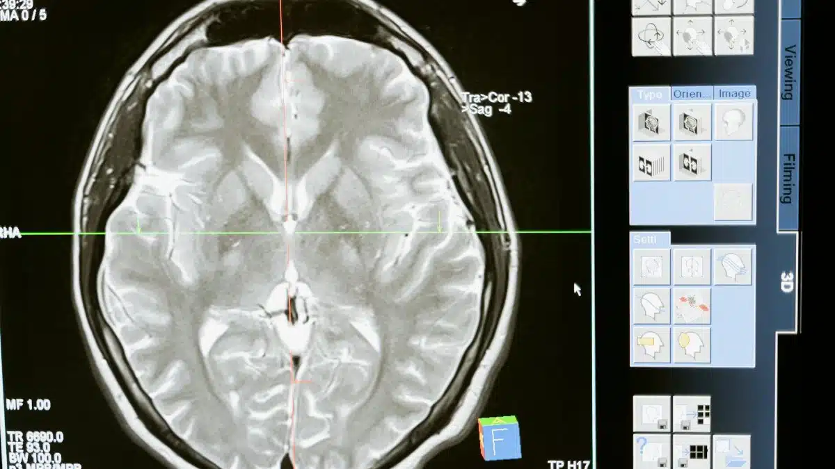 Intricate MRI brain scan displayed on a computer screen for medical analysis and diagnosis.