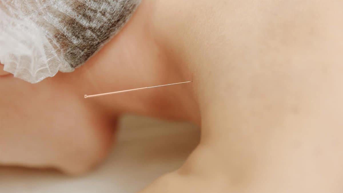 Detailed close-up image of an acupuncture needle inserted into skin, showcasing traditional Chinese medicine.