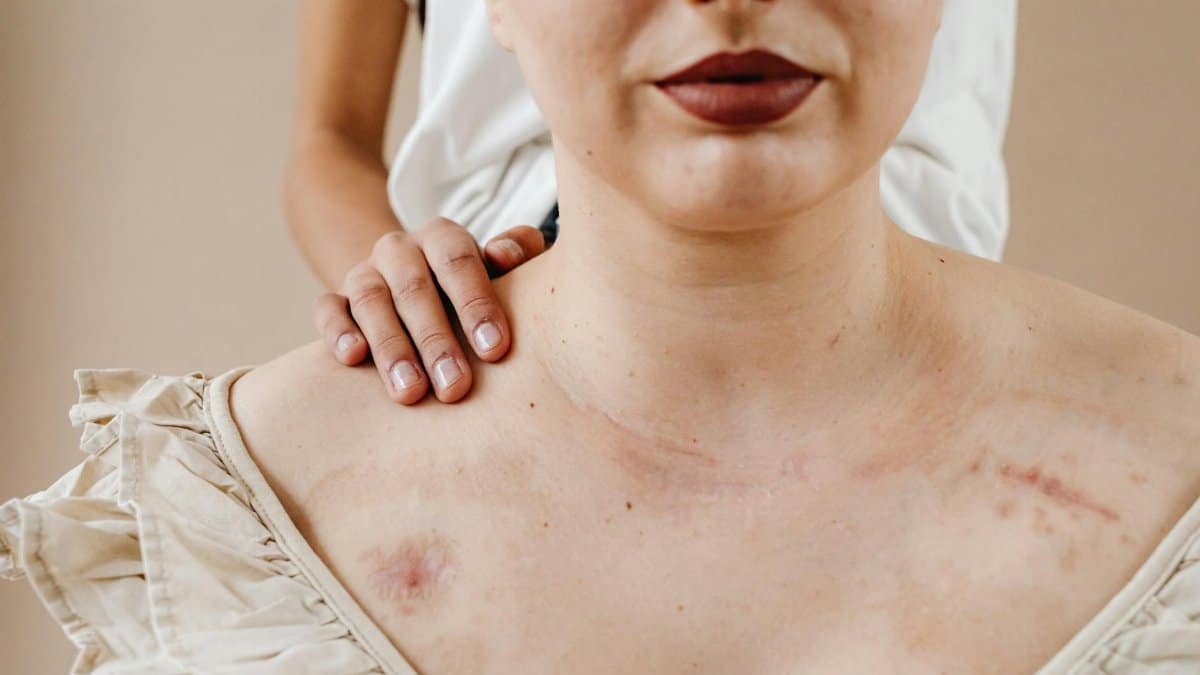 A comforting touch on a woman's shoulder displaying scars, symbolizing healing and support.